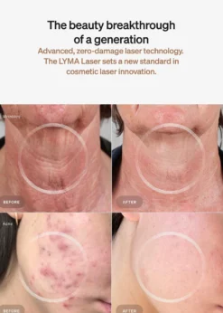 LYMALaser Starter Kit
